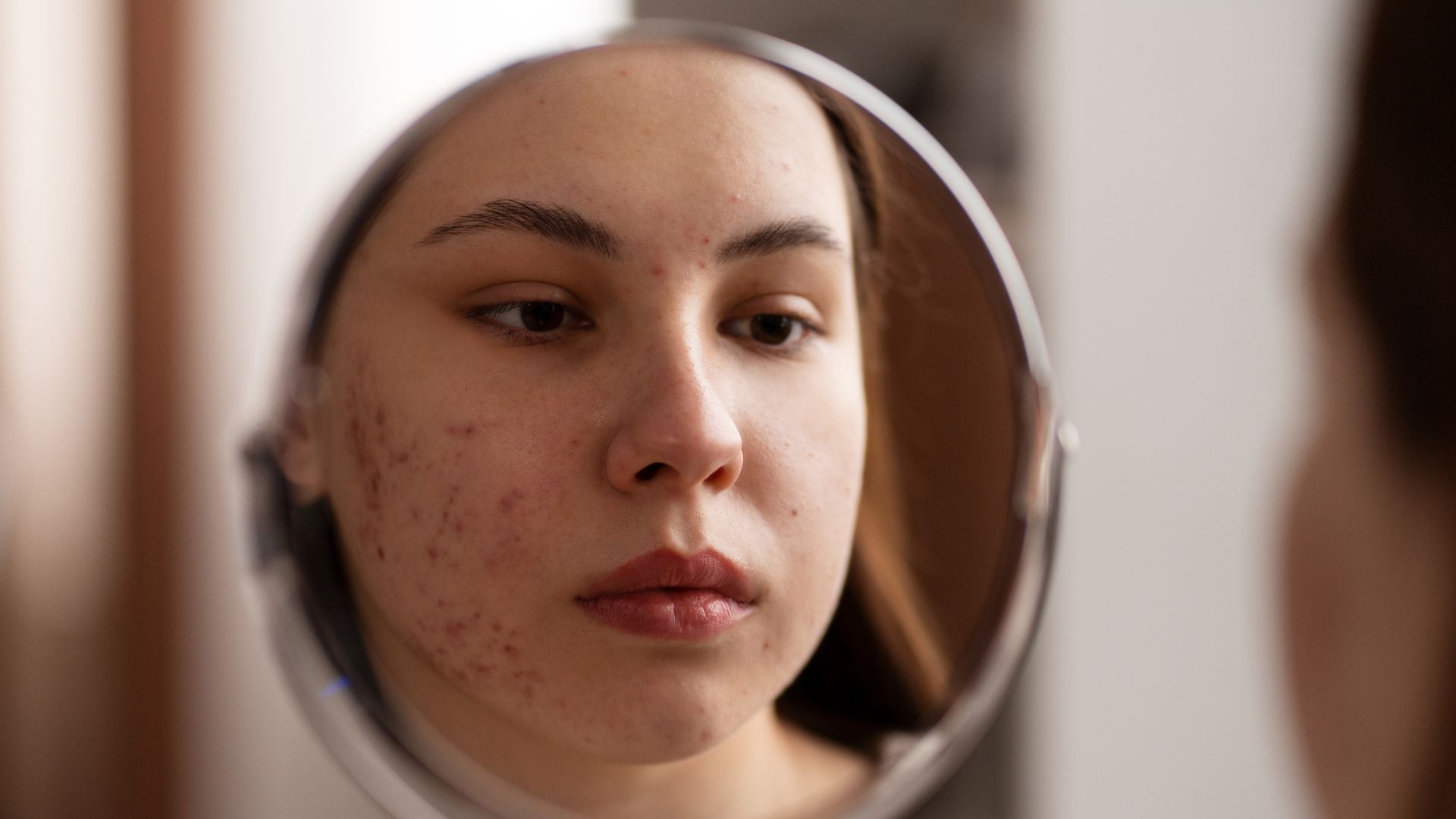 Decoding Pimple Patch Ingredients: Secrets Behind the Magic